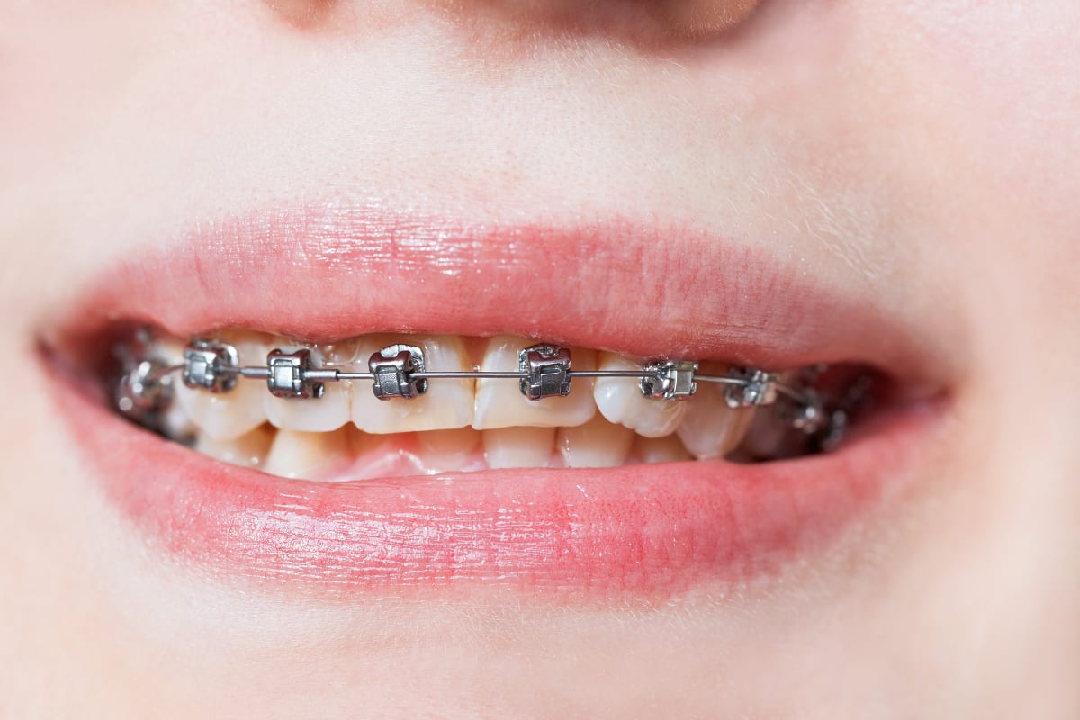 Damon Smile Self-ligating Braces